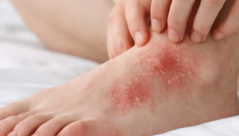 Pied rouge et irrité, avec des plaques blanches et des démangeaisons. Ce **psoriasis eczema pied** cause une gêne importante.