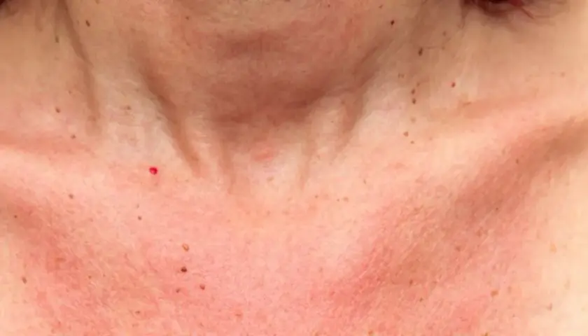 Peau rougie et irritée sur le cou et le décolleté, signe d'une réaction au soleil. Des grains de beauté sont visibles.