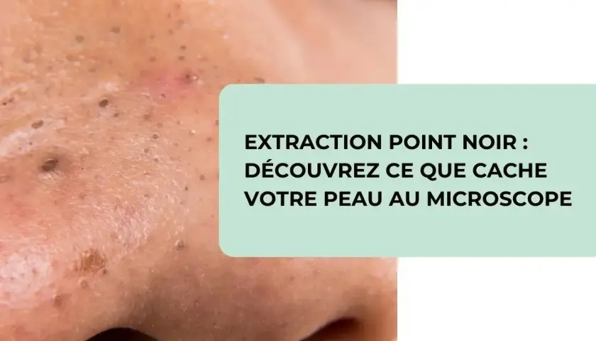 Gros plan sur une peau présentant des points noirs, avec un texte invitant à découvrir ce que cache votre peau au microscope lors de l'extraction de points noirs.