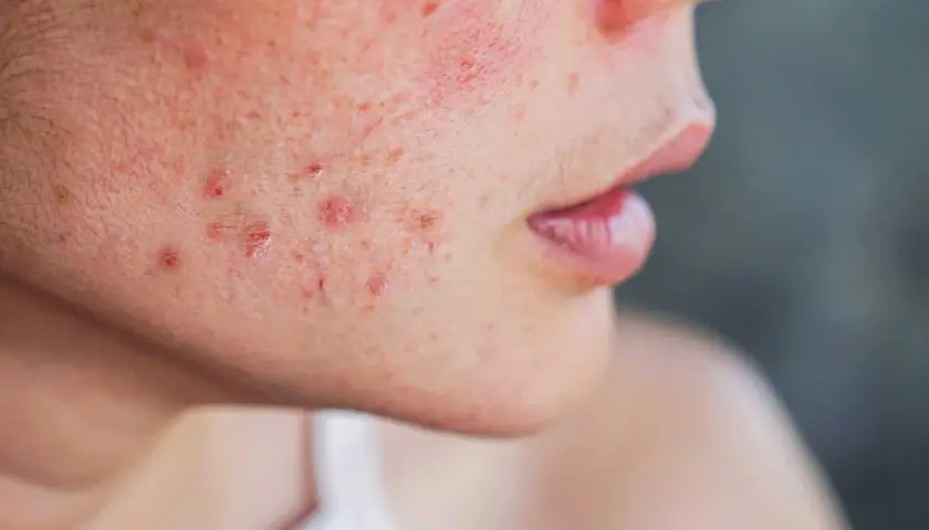 Gros plan sur le visage d'une personne montrant des rougeurs et des papules, symptômes de la rosacée papulo-pustuleuse.
