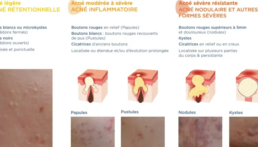Illustration des différents types d'acné : rétentionnelle (points blancs/noirs), inflammatoire (papules, pustules) et sévère (nodules, kystes).