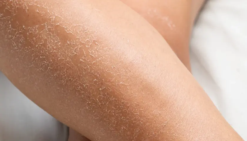 Gros plan sur des jambes sèches, la peau craquelée ressemble à celle d'un lézard.