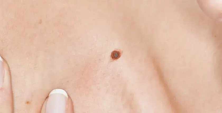 Gros plan sur une peau claire avec un grain de beauté brun foncé. Des doigts manucurés pointent vers la peau.