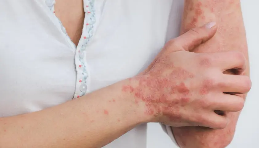 Main d'une personne atteinte de psoriasis, cherchant une cure psoriasis France. Les plaques rouges et squameuses sont visibles sur la main et le bras.