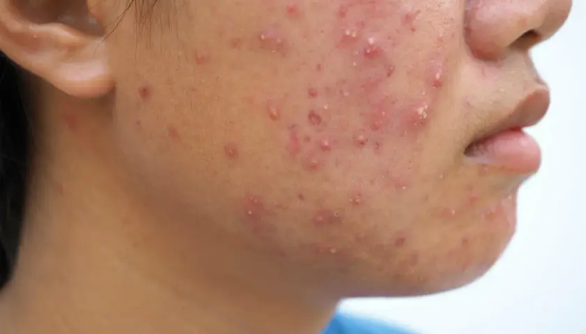 Gros plan sur le visage d'une personne présentant une éruption cutanée rouge et des boutons, possiblement de l'acné fongique.
