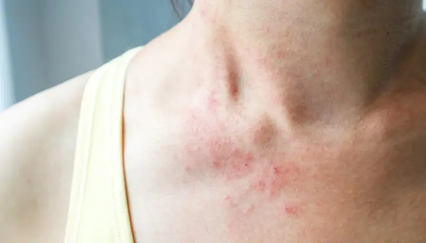 Rougeurs et petites lésions sur le cou et le décolleté, signes d'eczéma sur le corps.