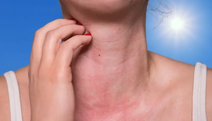 Une personne se gratte le cou, rouge et irrité, sous un soleil éclatant. Une réaction d'allergie soleil visage se manifeste.