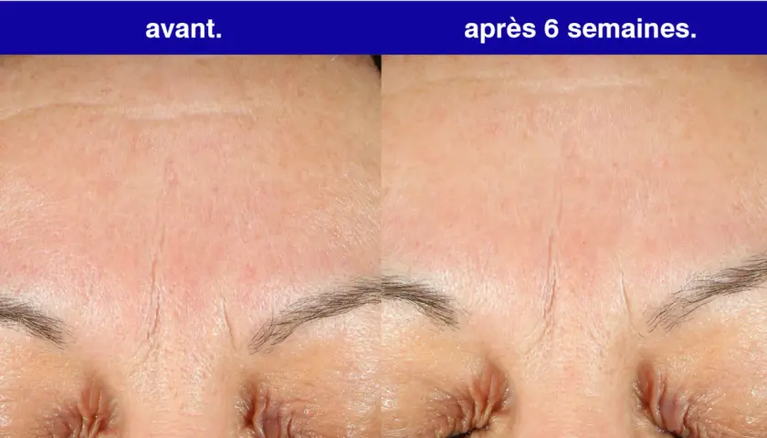 Front du visage avant et après 6 semaines d'utilisation de rétinol. Les rides sont visiblement atténuées.
