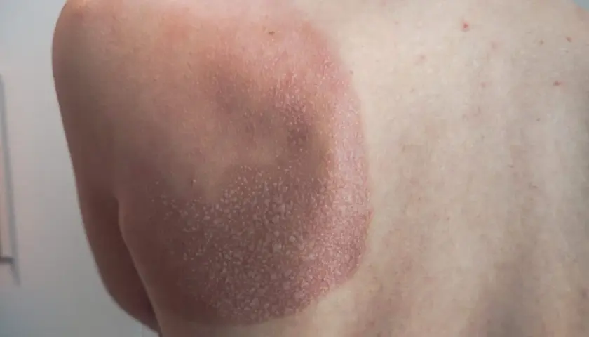 Une petite cloque d'eau sur la peau, signe d'un coup de soleil. La zone affectée est rouge et légèrement gonflée.