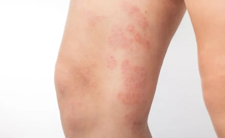 Plaque rouge sur les jambes - Causes, quand consulter et soulager