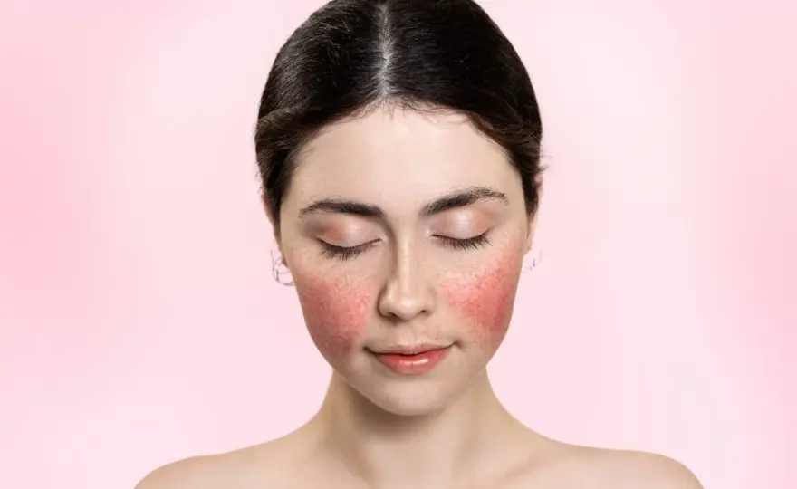 Rougeurs visage - Rosacée, couperose : comment les calmer ?