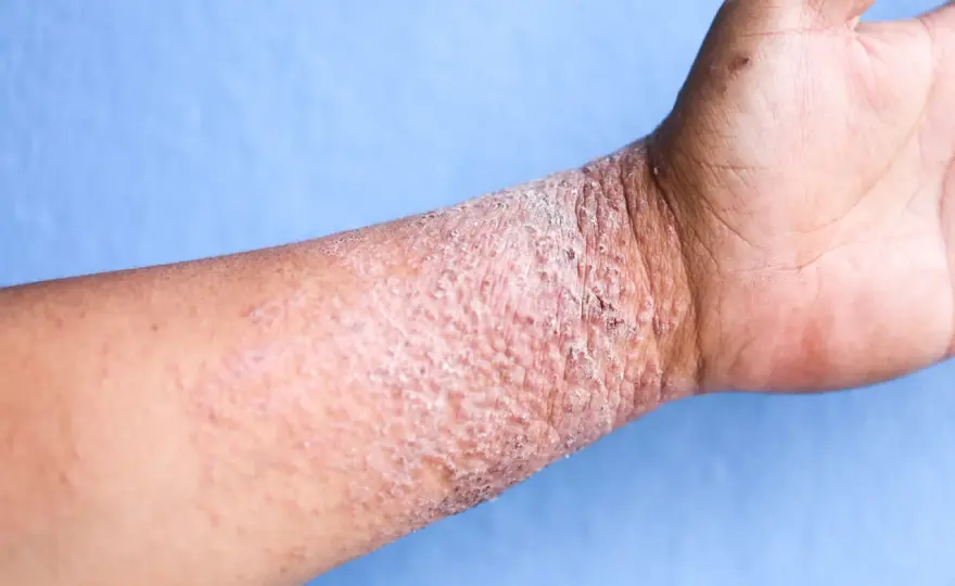 Dermatite atopique - les bons gestes pour apaiser la peau