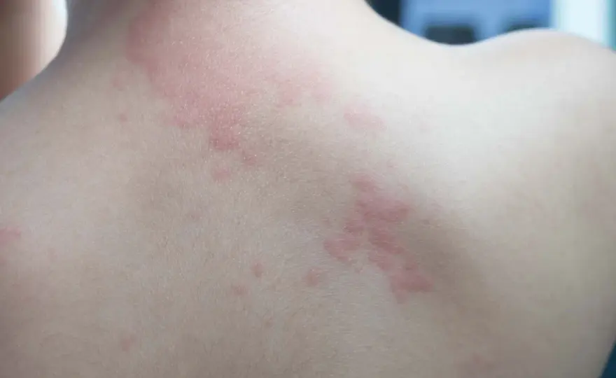 Réaction allergique cutanée - Reconnaître et apaiser votre peau