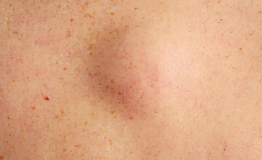 Bouton dur sous la peau - Kyste, lipome ou autre? Découvrez!