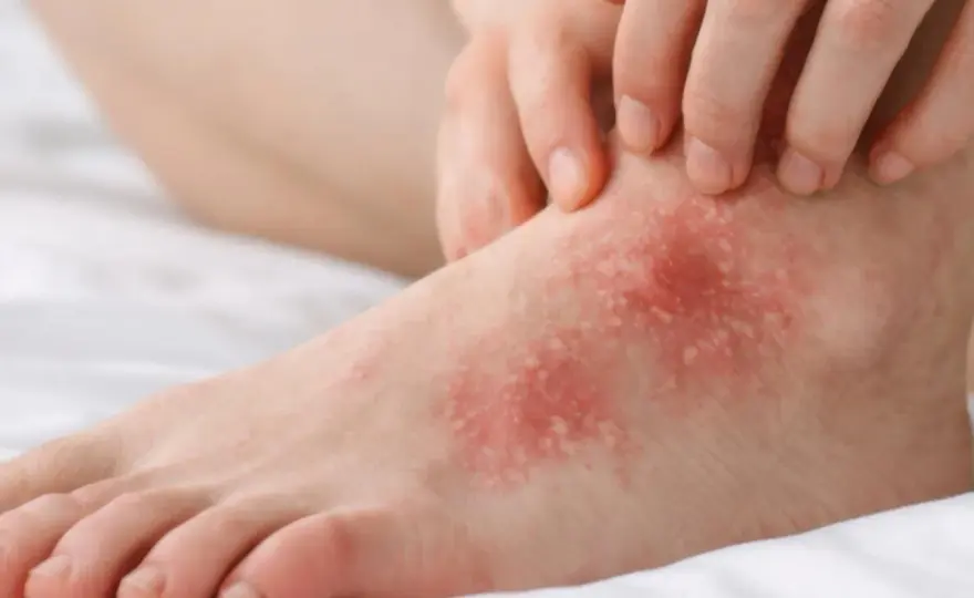 Psoriasis, eczéma, mycose du pied - Comment les distinguer ?