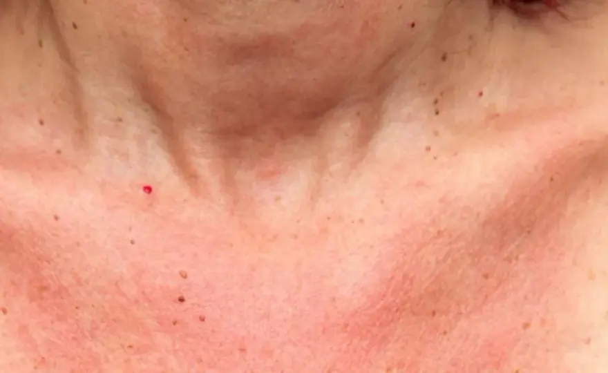Rougeur après soleil - Identifier, calmer, prévenir
