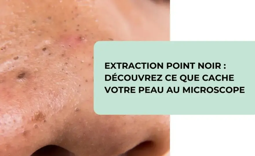 Gros points noirs - Extraire sans abîmer et éviter leur retour