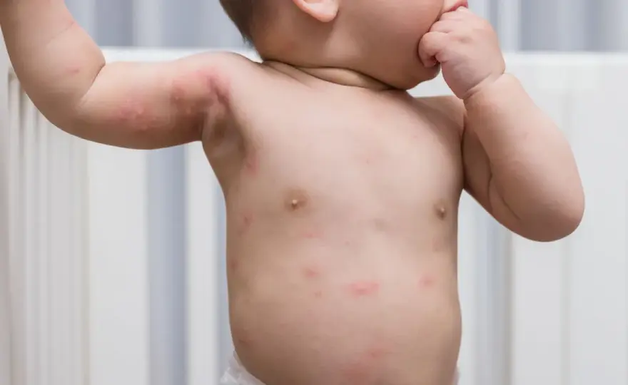 Boutons rouges bébé - Causes, soins et quand consulter