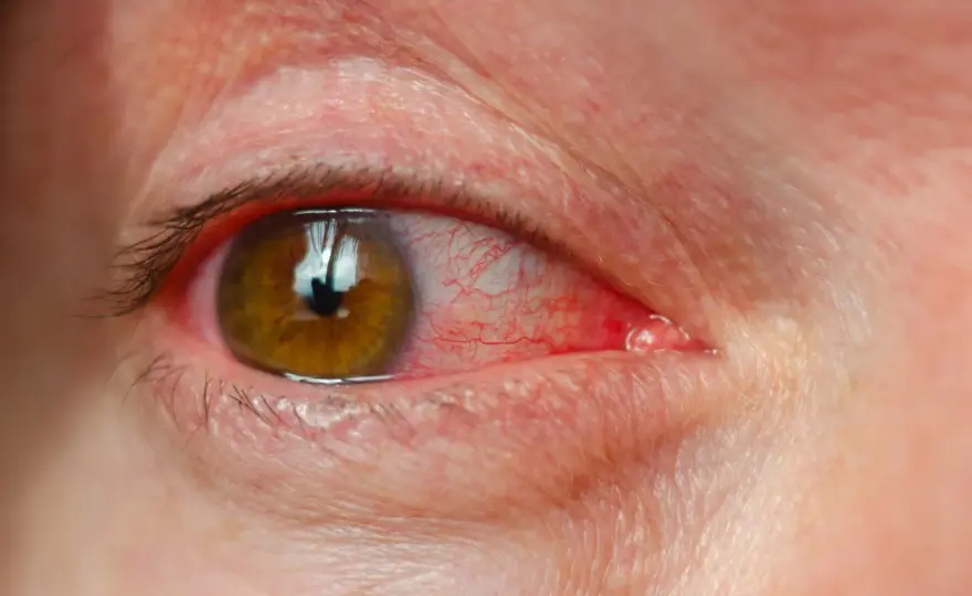 Paupière rouge - Causes, soins et quand consulter?