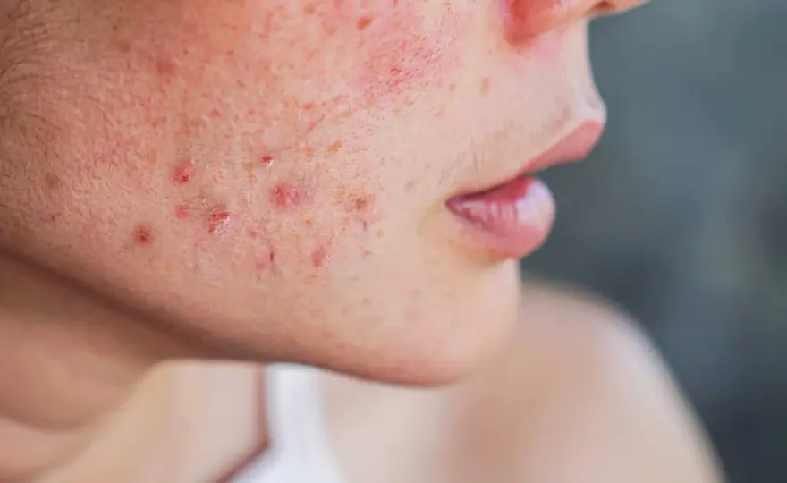 Rosacée papulo-pustuleuse - Calmez votre peau durablement