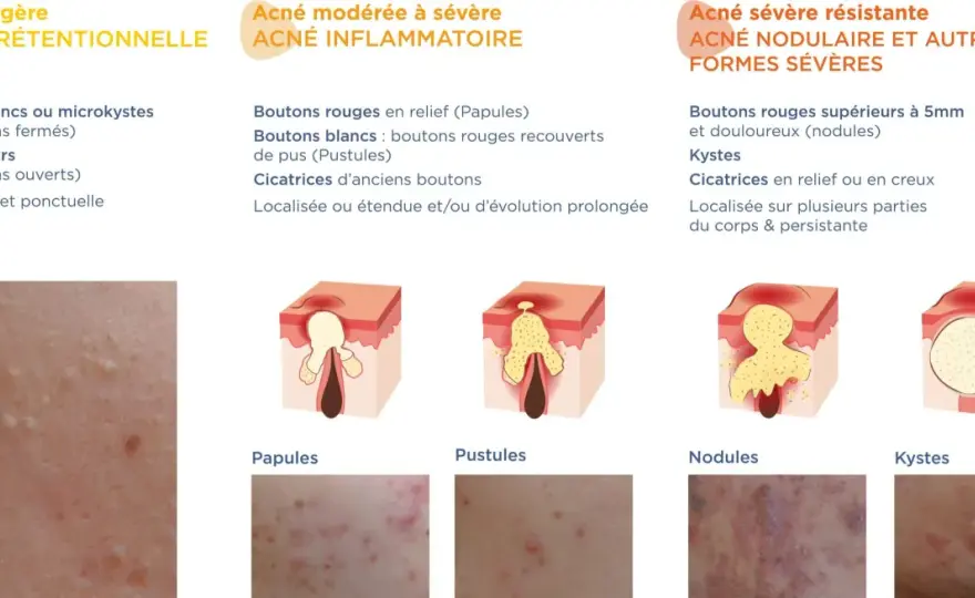 Types d'acné - Reconnaître et soigner chaque bouton efficacement