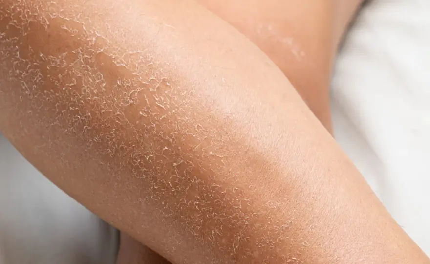 Jambes sèches et squameuses - La routine qui répare vraiment