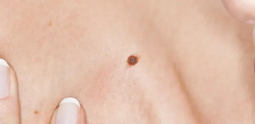 Nouveau grain de beauté - Quand s'inquiéter et comment agir ?