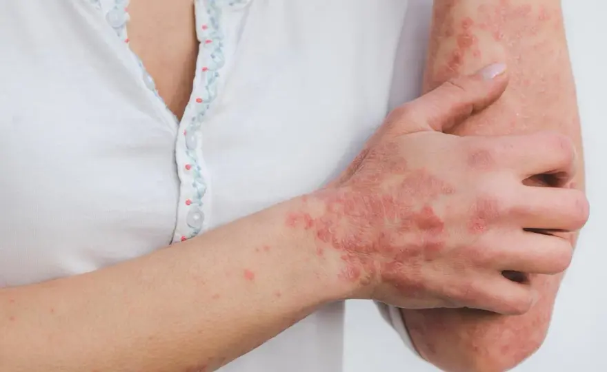 Cure thermale psoriasis - Le guide complet pour choisir sa station