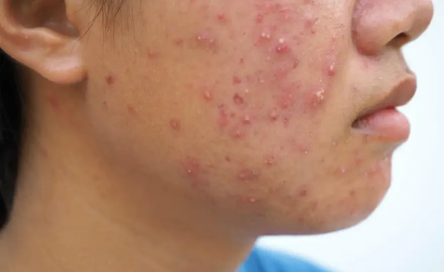 Acné fongique - Votre peau démange? Causes et solutions efficaces
