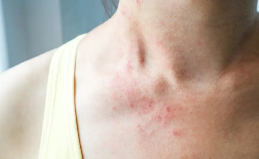 Eczéma sur le corps - Causes, traitements et routine efficace
