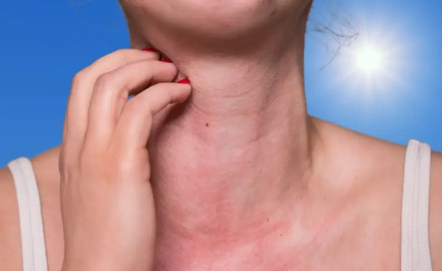 Allergie au soleil visage - Calmer rougeurs et boutons