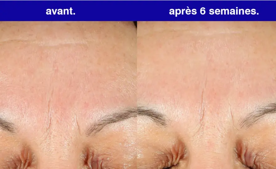 Rétinol visage avant après - Vrai résultat ou illusion?