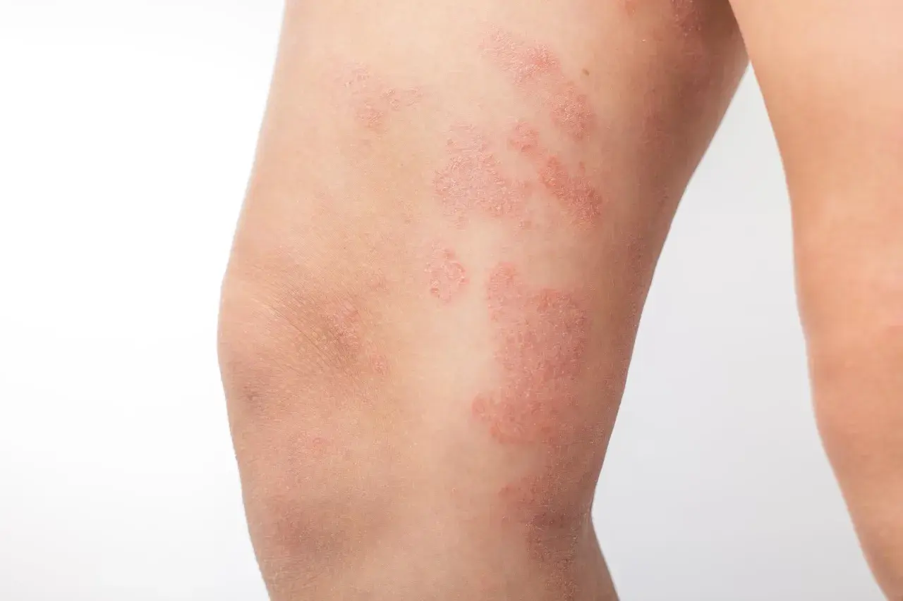 Plaques rouges et squameuses sur la peau des jambes, indiquant une affection cutanée.