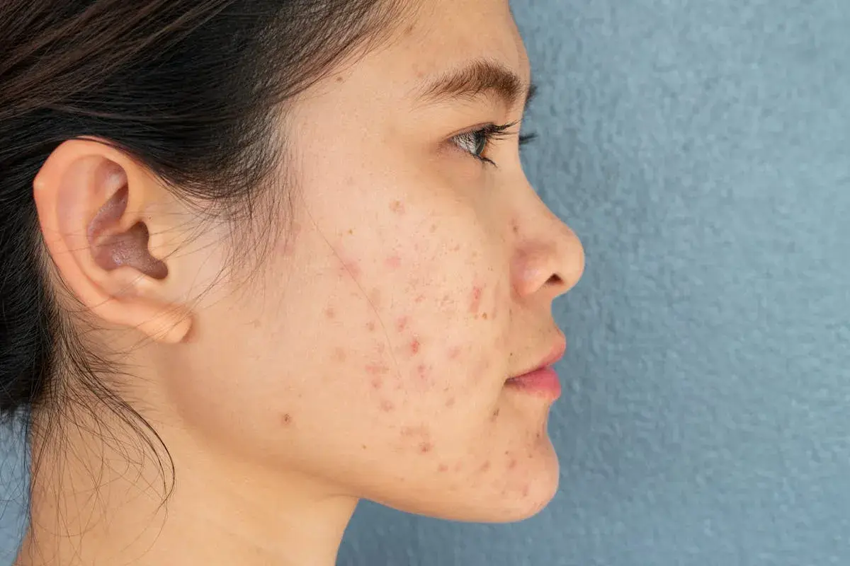 Profil d'une jeune femme avec une peau marquée par des rougeurs et des imperfections, évoquant une **cicatrice zona** ou de l'acné.