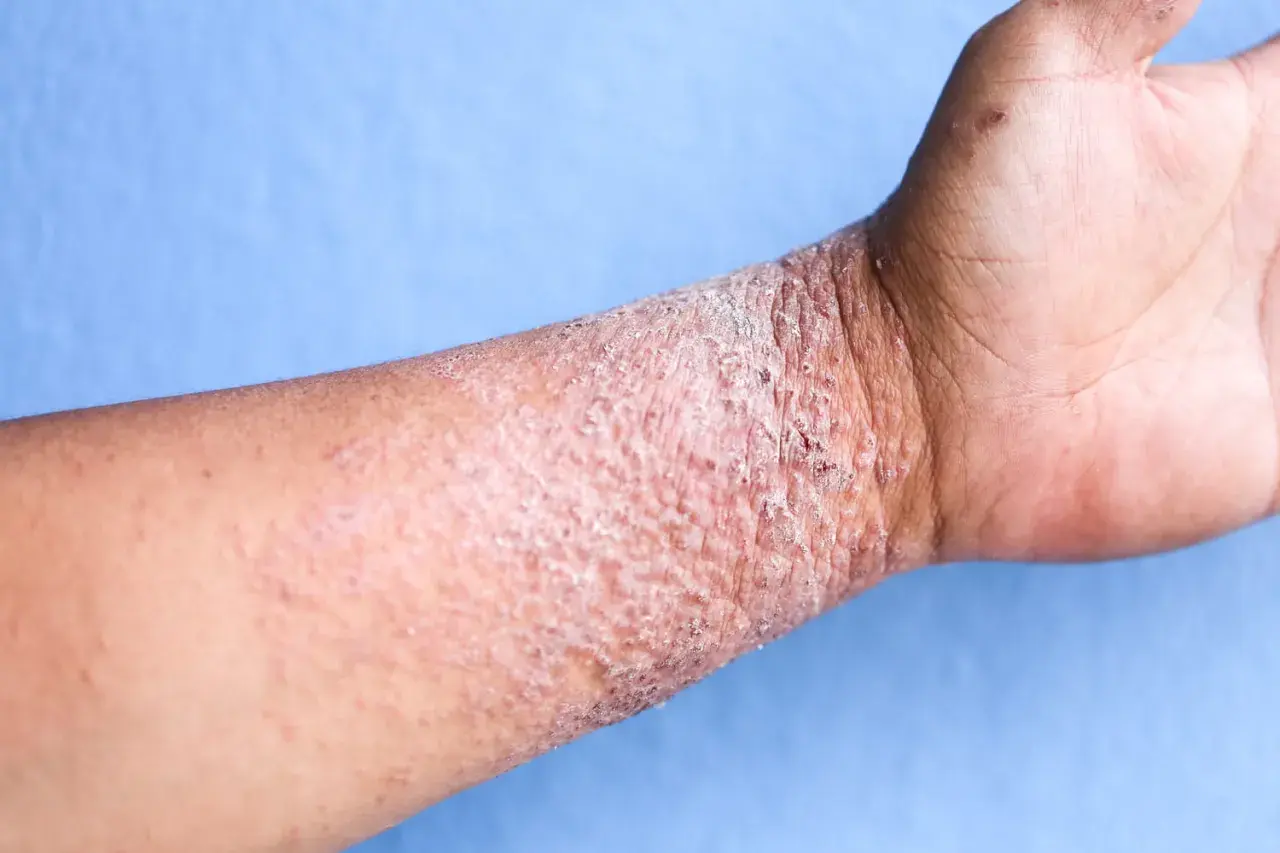 Poignet atteint de dermatite atopique, avec peau rouge, squameuse et irritée.
