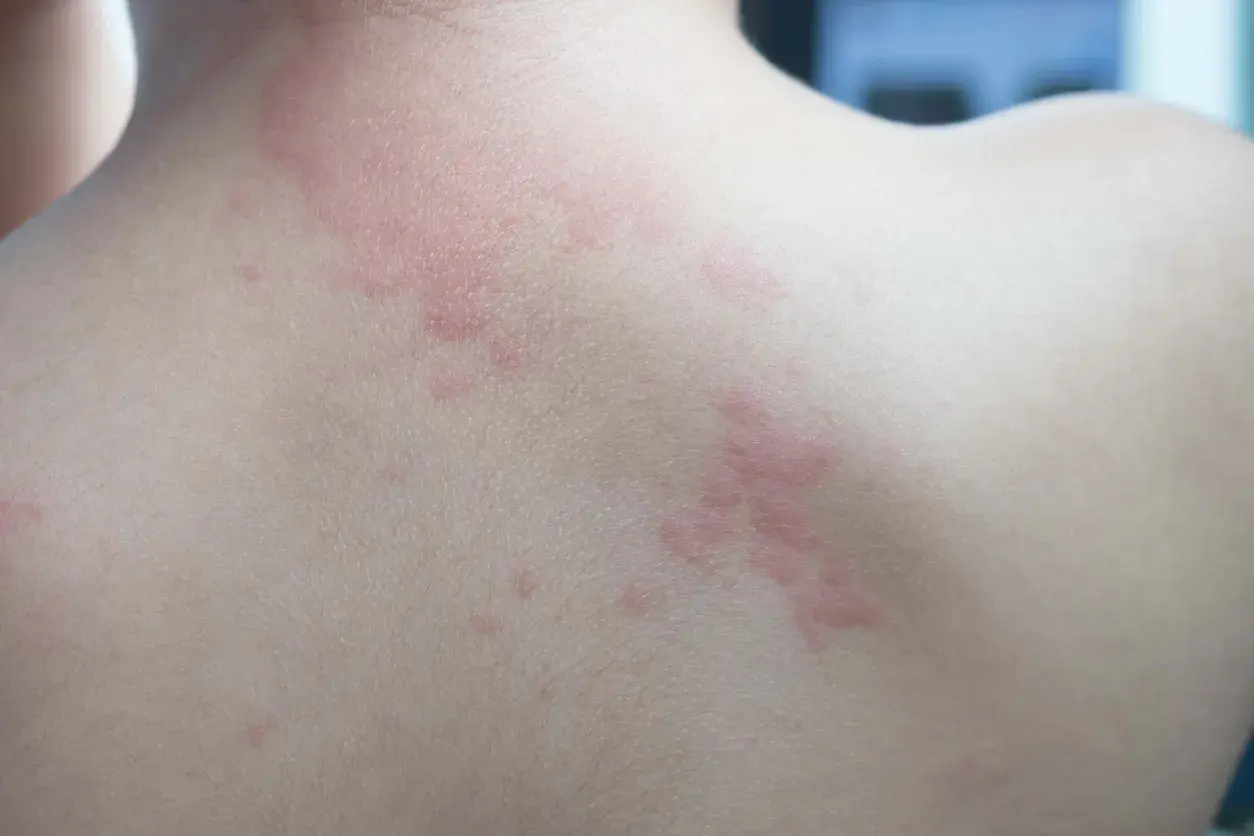 Plaques rouges et surélevées sur le dos, signes de boutons allergie.