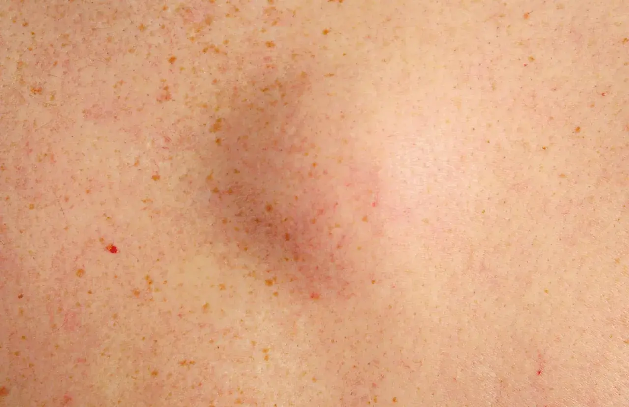 Gros plan sur une peau tachetée de rousseur, avec un bouton dur sous la peau légèrement rouge et gonflé au centre.