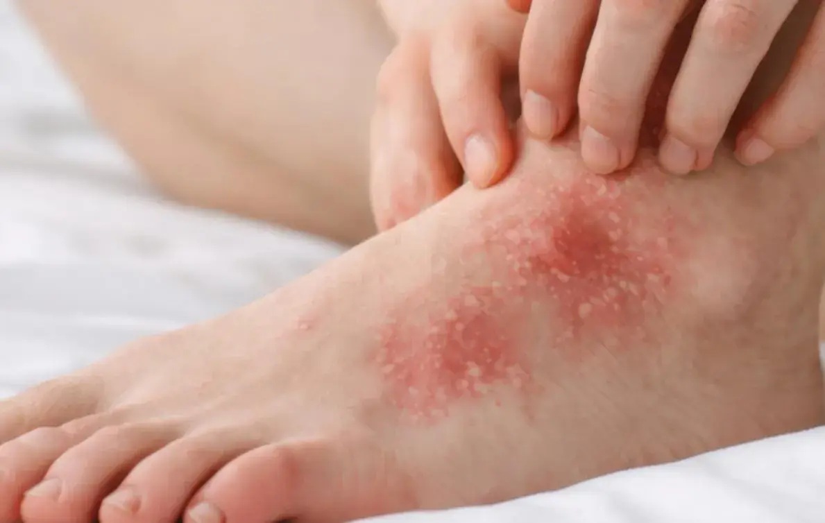 Pied rouge et irrité, avec des plaques blanches et des démangeaisons. Ce **psoriasis eczema pied** cause une gêne importante.