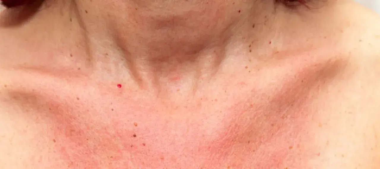 Peau rougie et irritée sur le cou et le décolleté, signe d'une réaction au soleil. Des grains de beauté sont visibles.