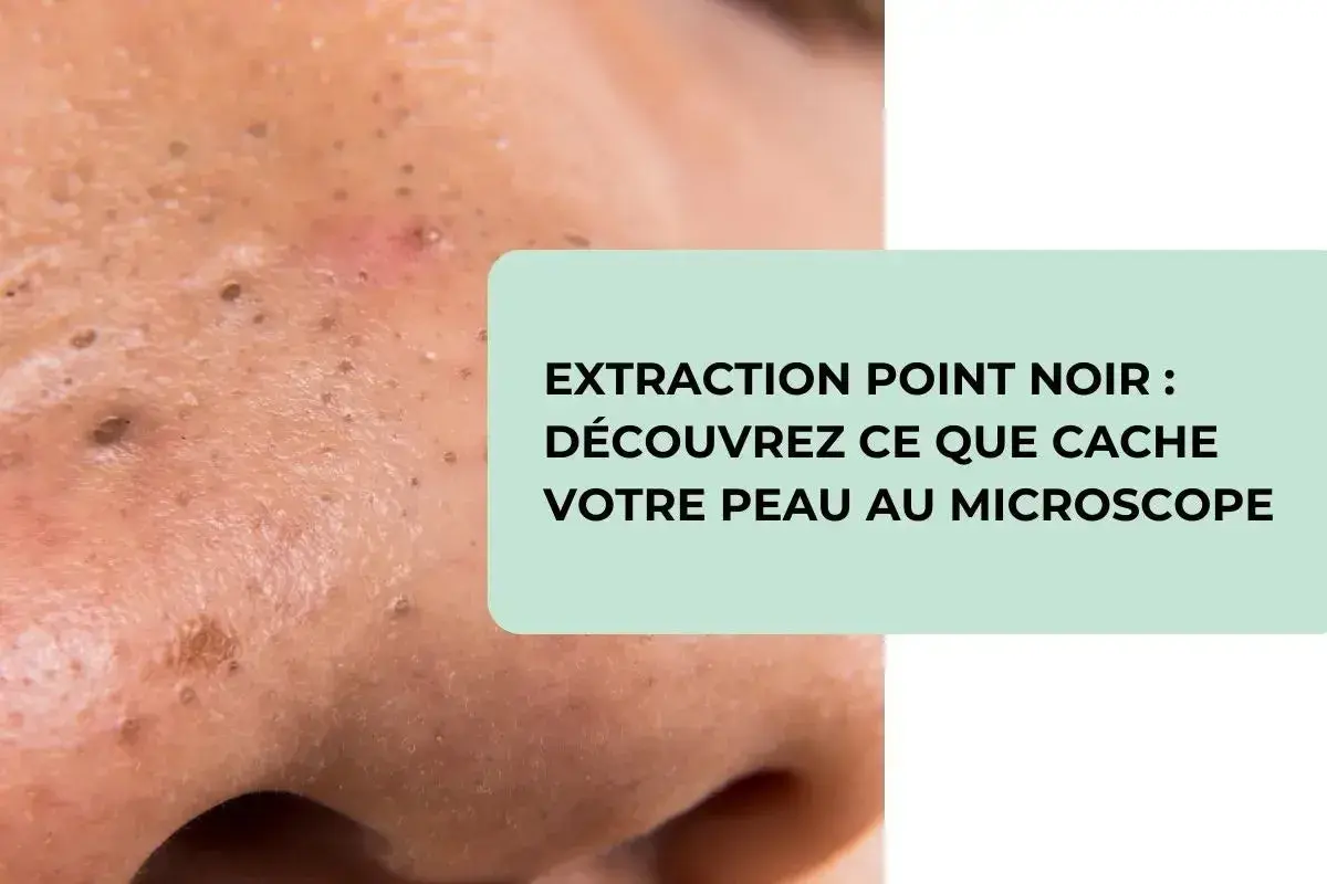 Gros plan sur une peau présentant des points noirs, avec un texte invitant à découvrir ce que cache votre peau au microscope lors de l'extraction de points noirs.