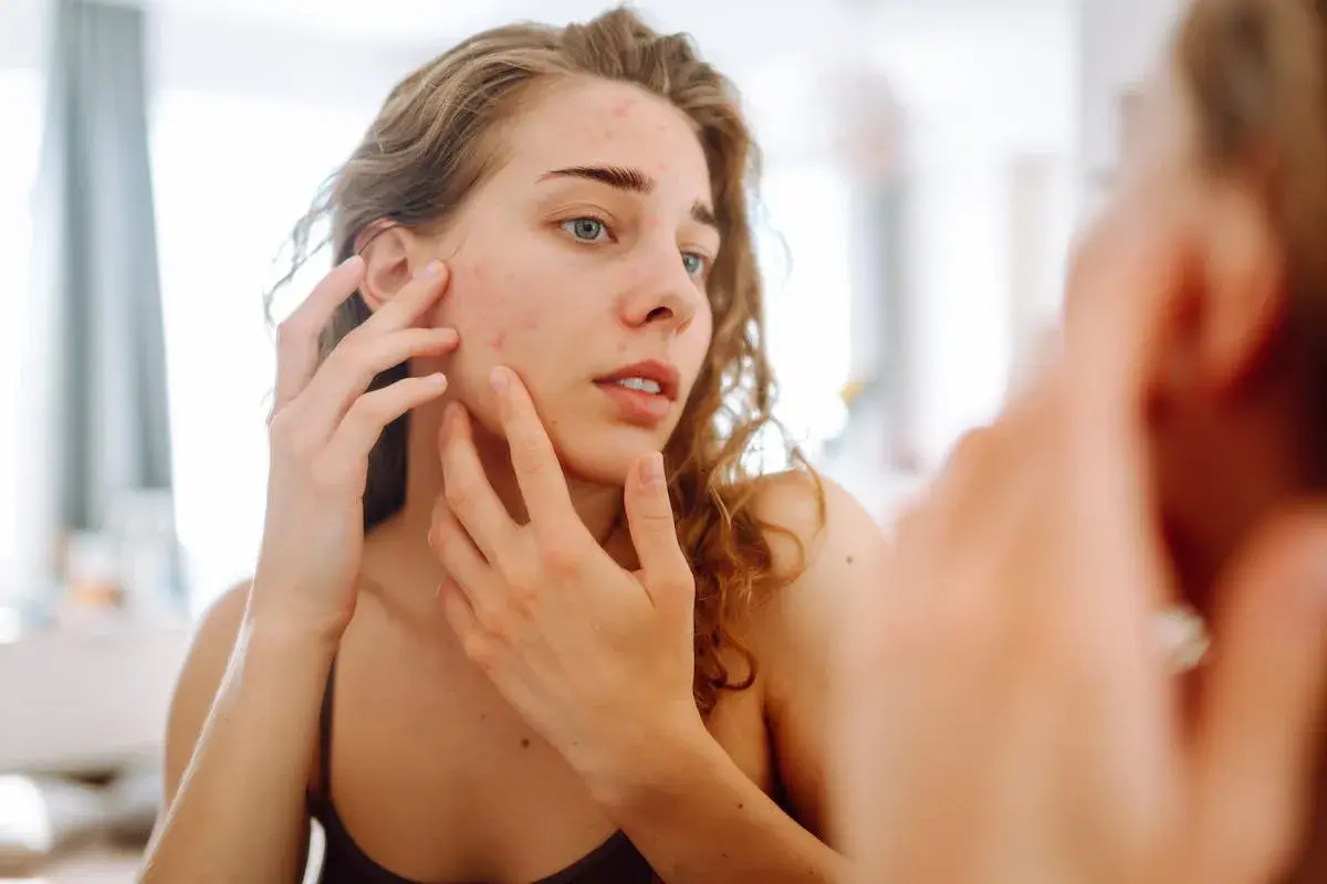 Jeune femme examinant son visage dans le miroir, préoccupée par son acné. Le soleil peut parfois aggraver ces imperfections cutanées.