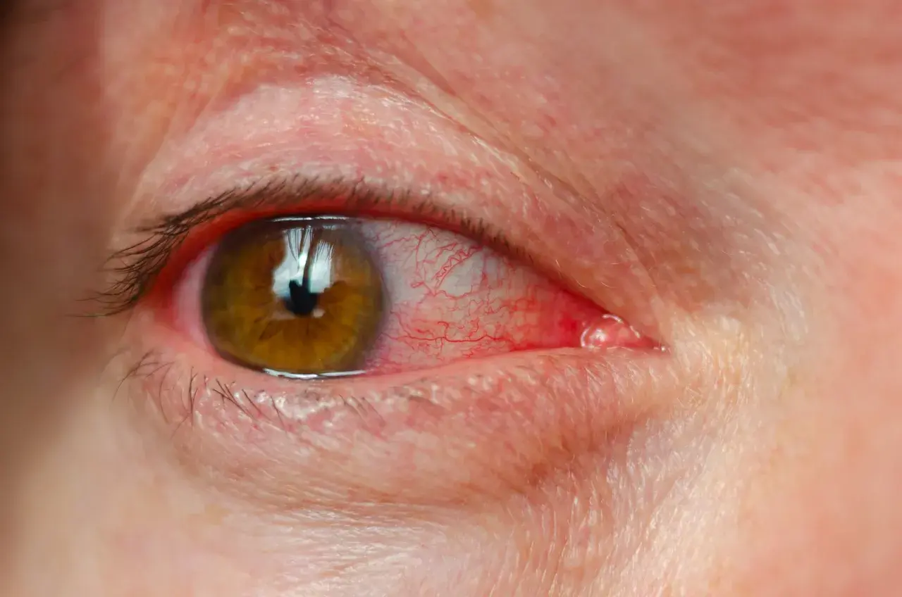 Œil humain avec conjonctive rouge et une petite tache rouge sur la paupière supérieure.