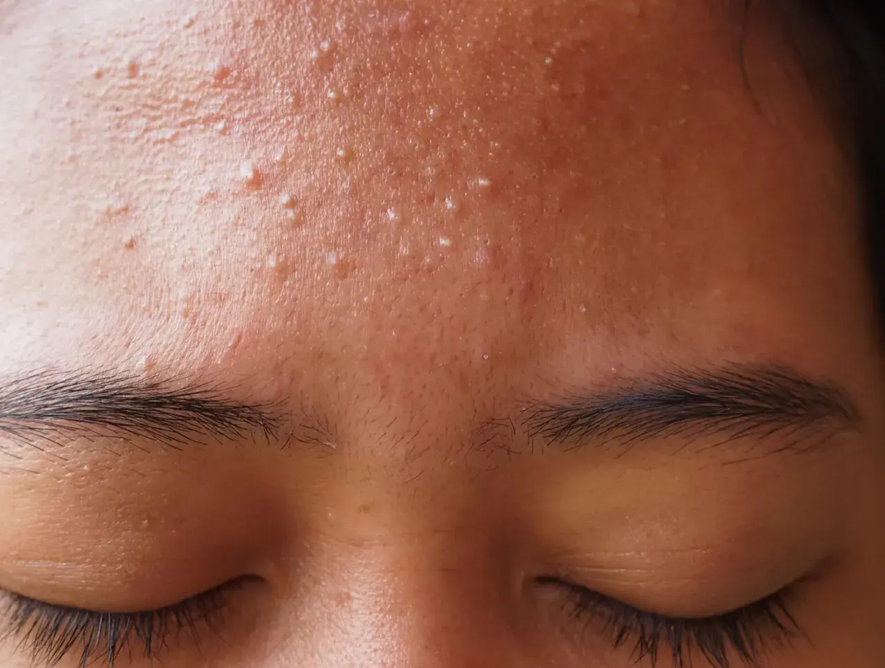 Gros plan sur le front d'une personne, montrant des pores bouchés et de nombreux points blancs. Les yeux sont fermés, les cils longs et sombres.