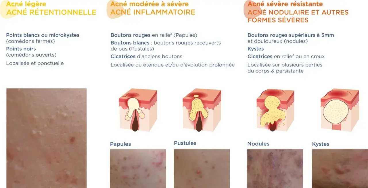 Illustration des différents types d'acné : rétentionnelle (points blancs/noirs), inflammatoire (papules, pustules) et sévère (nodules, kystes).