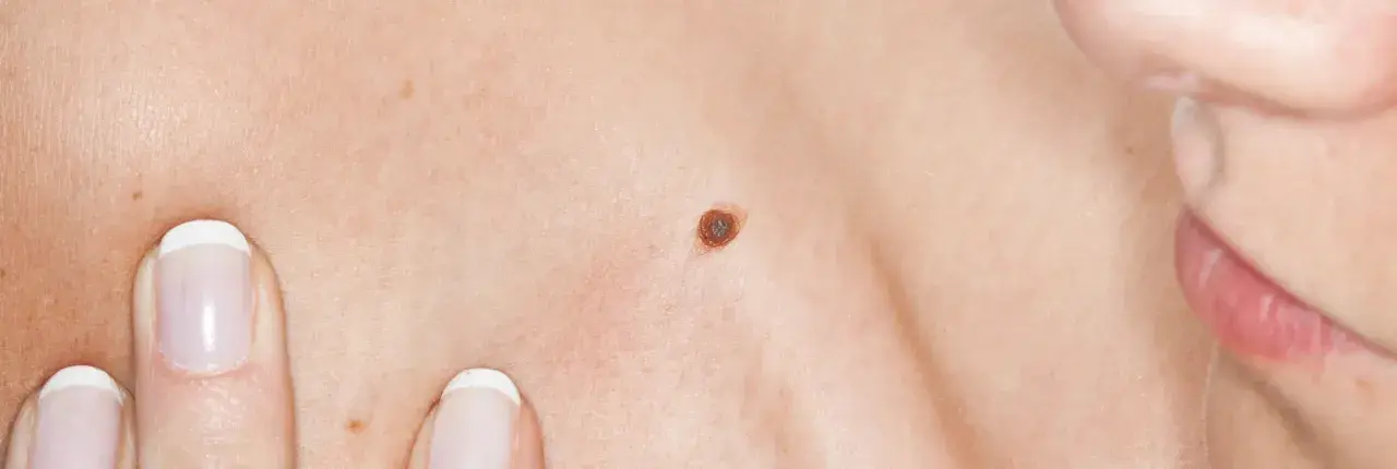 Gros plan sur une peau claire avec un grain de beauté brun foncé. Des doigts manucurés pointent vers la peau.