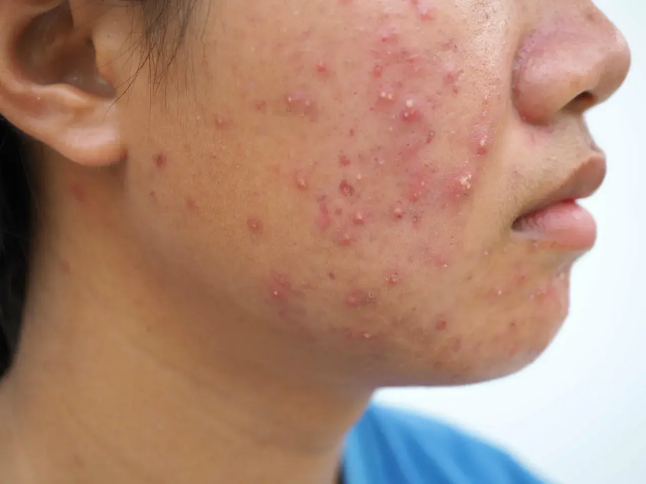 Gros plan sur le visage d'une personne présentant une éruption cutanée rouge et des boutons, possiblement de l'acné fongique.