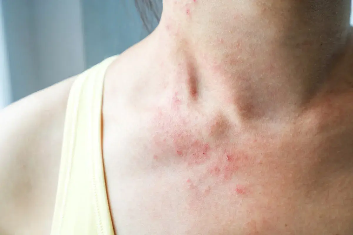 Rougeurs et petites lésions sur le cou et le décolleté, signes d'eczéma sur le corps.