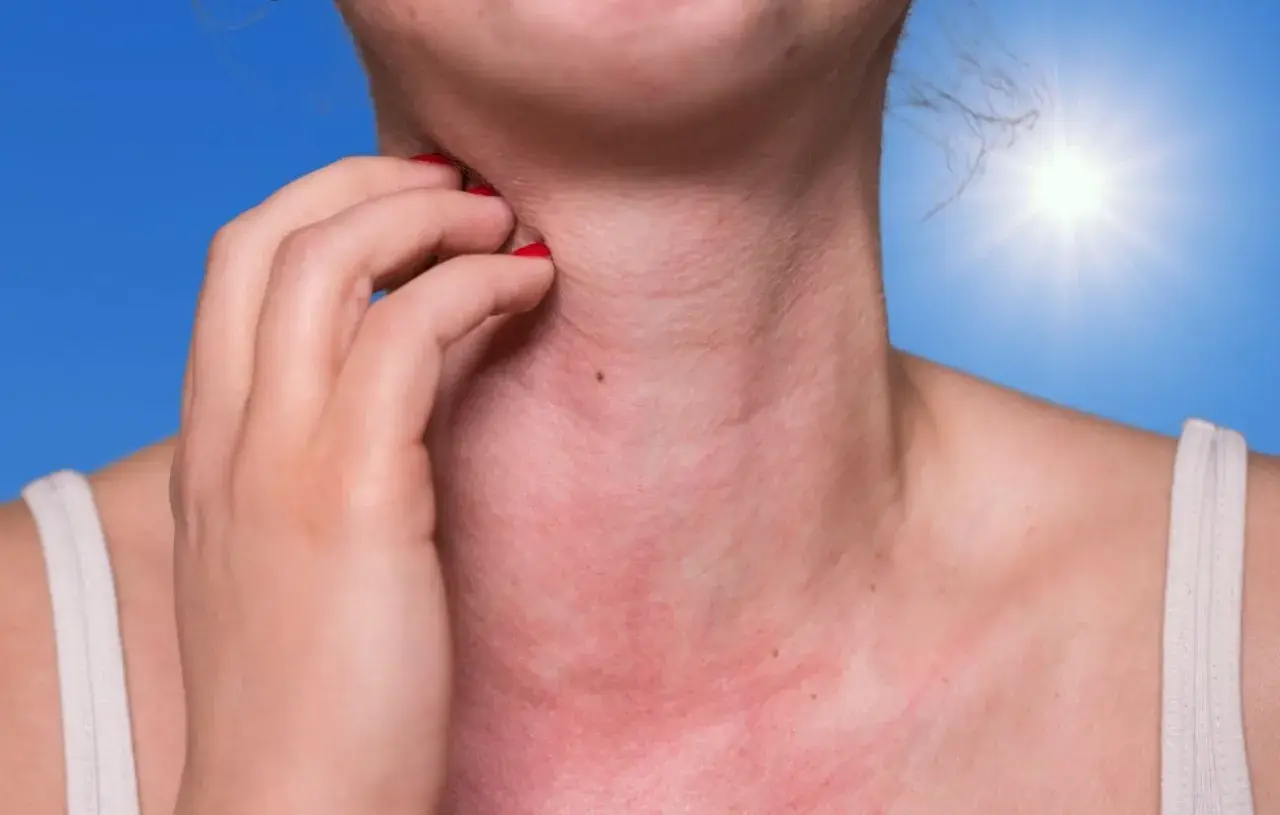 Une personne se gratte le cou, rouge et irrité, sous un soleil éclatant. Une réaction d'allergie soleil visage se manifeste.