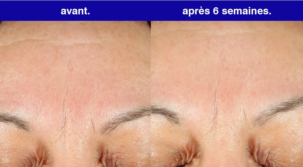 Front du visage avant et après 6 semaines d'utilisation de rétinol. Les rides sont visiblement atténuées.