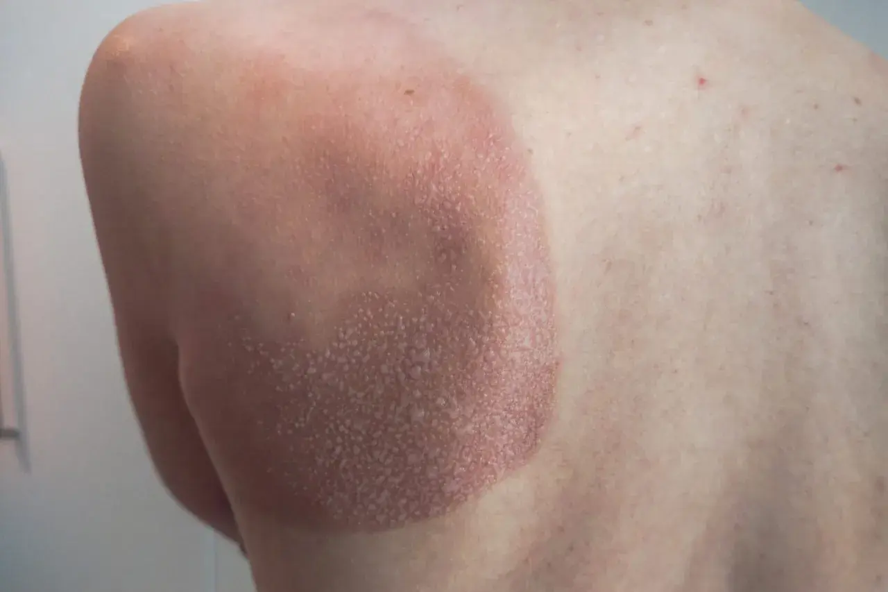 Une petite cloque d'eau sur la peau, signe d'un coup de soleil. La zone affectée est rouge et légèrement gonflée.